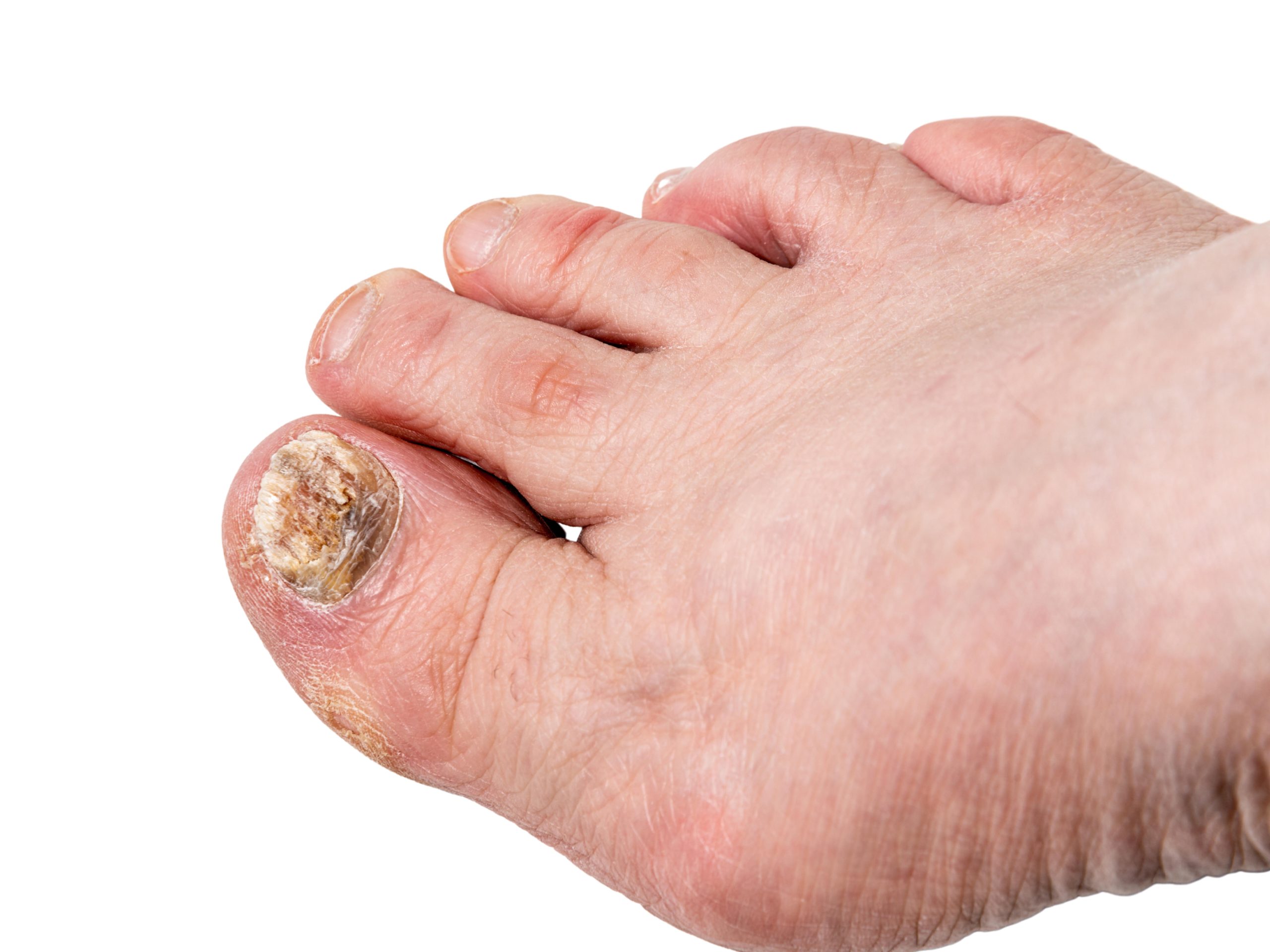 Bay Region Foot and Ankle Toe Nail Disorders